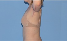 Arm Lift After Photo by Siamak Agha, MD PhD FACS; Newport Beach, CA - Case 44114