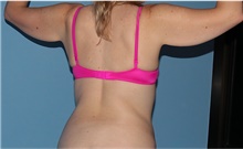 Arm Lift Before Photo by Siamak Agha, MD PhD FACS; Newport Beach, CA - Case 44114