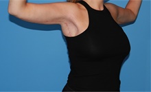 Arm Lift After Photo by Siamak Agha, MD PhD FACS; Newport Beach, CA - Case 44133