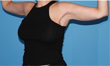 Arm Lift After Photo by Siamak Agha, MD PhD FACS; Newport Beach, CA - Case 44133