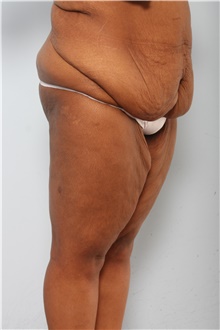 Body Lift Before Photo by Paul Vitenas, Jr., MD; Houston, TX - Case 44872