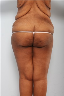 Body Lift Before Photo by Paul Vitenas, Jr., MD; Houston, TX - Case 44872