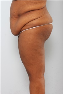 Body Lift Before Photo by Paul Vitenas, Jr., MD; Houston, TX - Case 44872