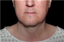 Liposuction After Photo by Landon Pryor, MD, FACS; Rockford, IL - Case 45044