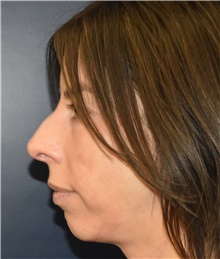 Rhinoplasty Before Photo by Richard Reish, MD, FACS; New York, NY - Case 45326