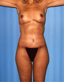 Body Lift After Photo by Siamak Agha, MD PhD FACS; Newport Beach, CA - Case 46680