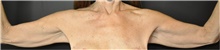 Arm Lift Before Photo by Keyian Paydar, MD, FACS; Newport Beach, CA - Case 46981
