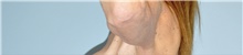 Arm Lift After Photo by Keyian Paydar, MD, FACS; Newport Beach, CA - Case 46981