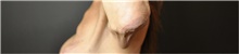 Arm Lift Before Photo by Keyian Paydar, MD, FACS; Newport Beach, CA - Case 46981