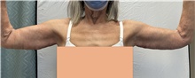 Arm Lift After Photo by Mark McRae, MD, FRCS(C); Burlington, ON - Case 46994