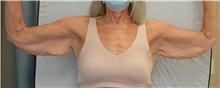 Arm Lift Before Photo by Mark McRae, MD, FRCS(C); Burlington, ON - Case 46994