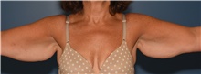 Arm Lift Before Photo by Derek Cody, MD, FACS; Akron, OH - Case 47241
