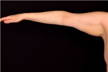 Arm Lift Before Photo by Landon Pryor, MD, FACS; Rockford, IL - Case 47464