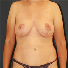 Mommy Makeover After Photo by Steve Laverson, MD, FACS; Rancho Santa Fe, CA - Case 47901