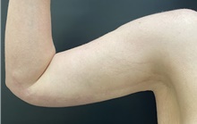 Arm Lift After Photo by Owen Reid, MD; Richmond, BC - Case 48245