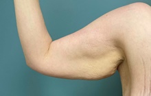 Arm Lift Before Photo by Owen Reid, MD; Richmond, BC - Case 48245