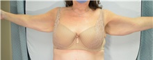 Arm Lift Before Photo by Mark McRae, MD, FRCS(C); Burlington, ON - Case 48356