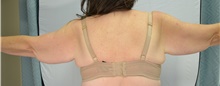 Arm Lift Before Photo by Mark McRae, MD, FRCS(C); Burlington, ON - Case 48356