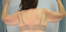 Arm Lift Before Photo by Mark McRae, MD, FRCS(C); Burlington, ON - Case 48356