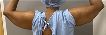 Arm Lift Before Photo by Keshav Magge, MD; Bethesda, MD - Case 48452