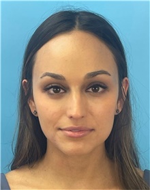 Rhinoplasty Before Photo by Mark Markarian, MD, MSPH, FACS; Wellesley, MA - Case 48526