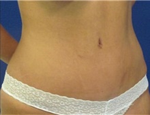 Tummy Tuck After Photo by Munique Maia, MD; Tysons Corner, VA - Case 48934