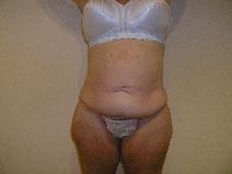 Body Contouring Before Photo by Joseph Fodero, MD; Florham Park, NJ - Case 9124