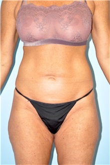 Body Lift Before Photo by Keyian Paydar, MD, FACS; Newport Beach, CA - Case 49576