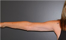 Arm Lift After Photo by Michele DeVito, MD FACS; Scottsdale, AZ - Case 49679