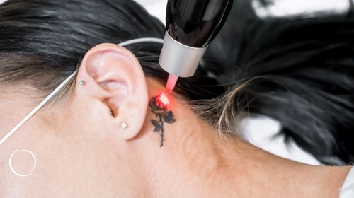 Regret or relief? Options for tattoo removal